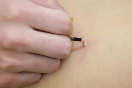 Il neurodermatitis a chi andare